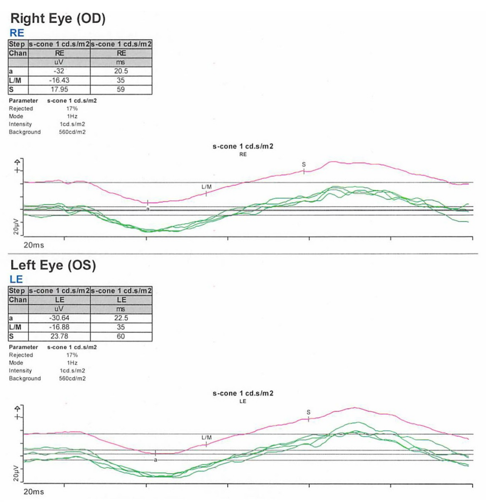 Figure 6. S-cone ERG, acquired in response to a blue wavelength on an orange wavelength background, demonstrated a greater than anticipated response OU.