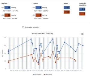 Figure 1: Summary of the results of iCare Home measurements taken three months prior to the glaucoma stent procedure OD. All the measurements were “excellent” in quality. Average IOP and variability of IOP was higher in the right eye, which had more glaucomatous damage compared to the left eye. Both average IOP and variability of IOP in OD were higher on these iCare measurements than on clinical measurements around the same time.