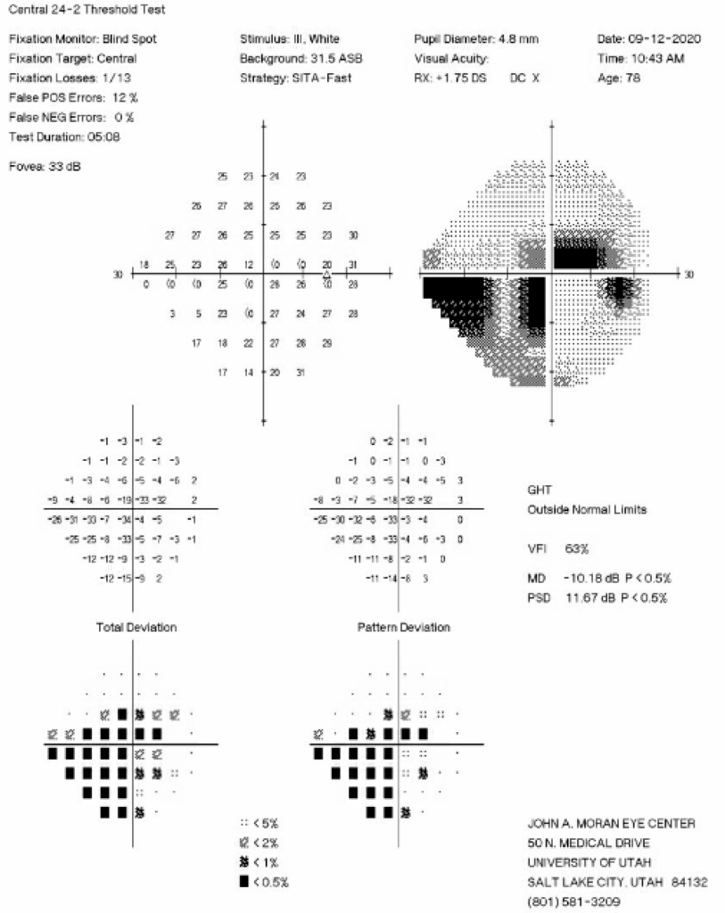 Figure 2: 24-2 Humphrey Visual Field test from six months prior to the initial iCare HOME measurements showing an inferior nasal step and pericentral visual field loss in the right eye.