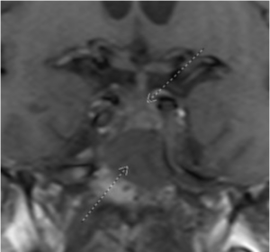 Figure 1: Coronal T1 view of a skull-based mass (inferior arrow) lying inferior to the optic chiasm (superior arrow)