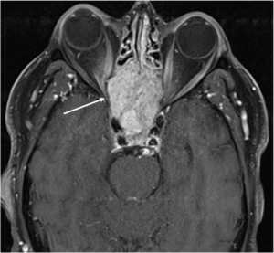 Figure 2: Axial T1, post-contrast view of a skull-based mass located in the sella