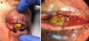 Figure 1A. External photograph of the patient’s left eye on post-operative day 2 following penetrating keratoplasty and secondary anterior chamber intraocular lens showing significant periorbital swelling, ecchymosis, and erythema as well purulent discharge and complete opacification of the cornea. Figure 1B. Magnified photo of the patient’s left eye showing nasal chemosis, opacity of the PK graft, and diffuse, perforate corneal ulcer. PK graft appears to be in place and thickened and elevated nasally.