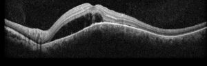 Johnson, Figure 2, OCT