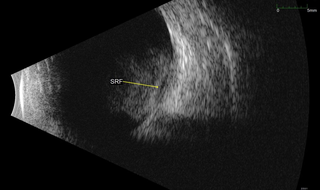 Terson Syndrome, Figure 1