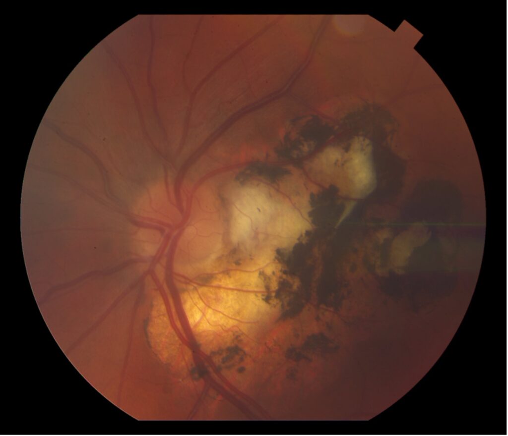 Wade, Figure 1, Left eye fundus