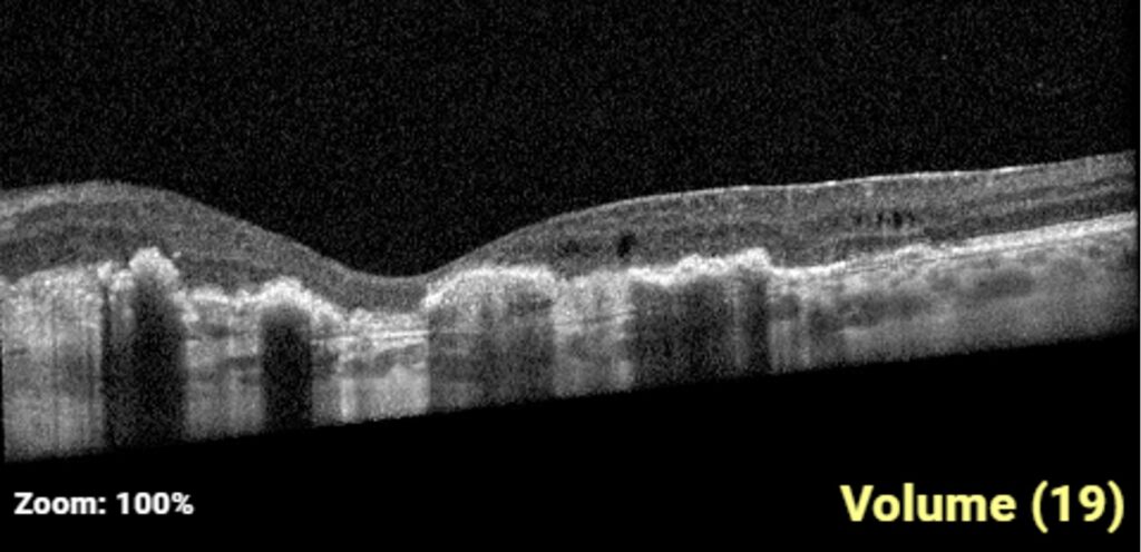 Wade, Figure 2, Mac OCT Left eye