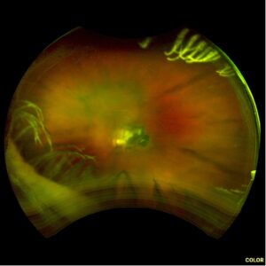 Wade, Figure 3, Left eye cataract