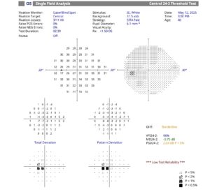 Chart demonstrating Humphrey 24-2 Visual Field Showing Central Loss (left eye).